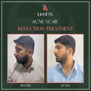 before after acne scar reduction treatment