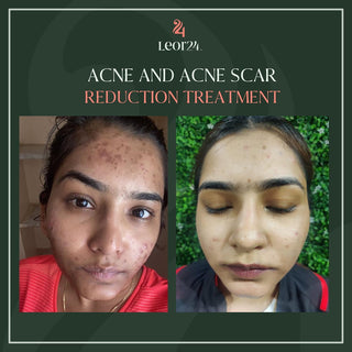 Acne & Scar reduction treatment - Before & After Results
