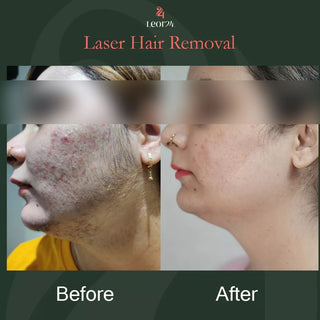 Laser Hair Treatment - Before & After Results