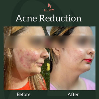 Acne Reduction Treatment - Before & After Result