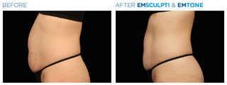 Fat Reduction Treatment at Leor Clinic