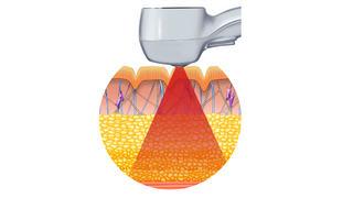 laser skin treatment targeting fat cells
