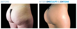 Fat Reduction Treatment at Leor Clinic