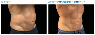 Fat Reduction Treatment at Leor Clinic