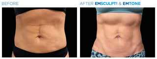 Abdomen threading - Before & After Results