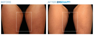 Fat Reduction Treatment at Leor Clinic