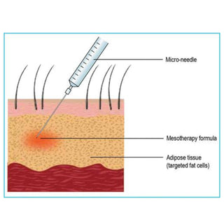 Mesotherapy injection targeting adipose tissue diagram