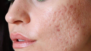 Acne Scar Treatment at Leor Clinic