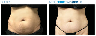 Fat Reduction Treatment at Leor Clinic