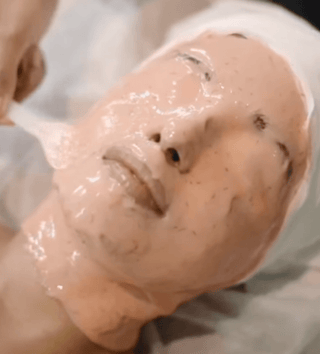 Chemical Peel treatment at Leor Clinic