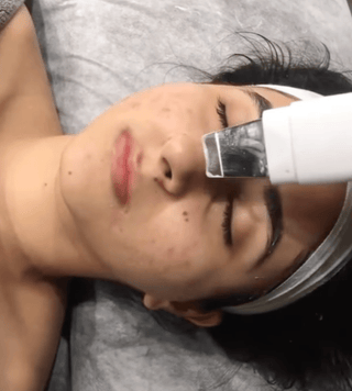 Woman getting facial laser treatment at Leor clinic
