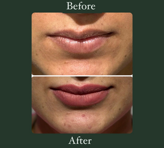 Lip Filler- Before & After Results