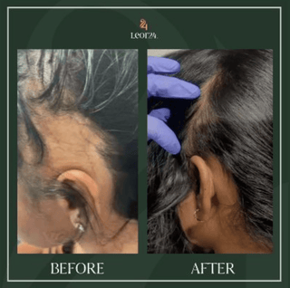 Hair regrowth treatment: before and after result