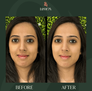 Anti Ageing - Before & After Results