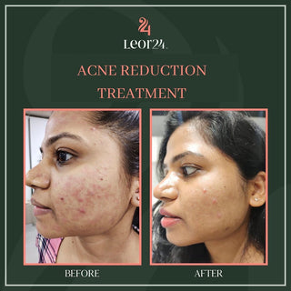 Acne reduction treatment - Before & After Results