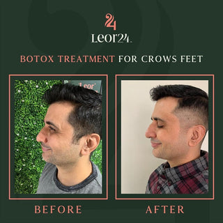 Botox Treatment - Before & After Results