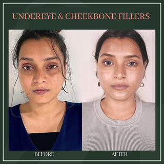 Undereye cheekbone filler - Before & After Results