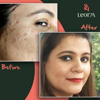 Skincare treatment - Before & After Results