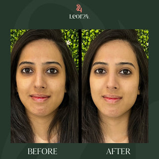 Skin Treatment - Before & After Result