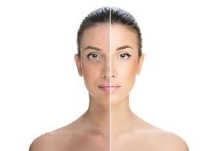 Skin Pigmentation Treatment at Leor Clinic