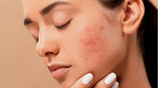 Skin Pigmentation Treatment at Leor Clinic