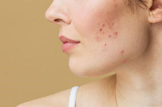 skin pigmentation treatment at Leor Clinic