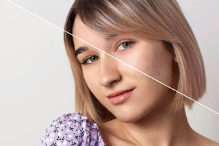 Before and After cosmetic Skin Treatment at Leor Clinic