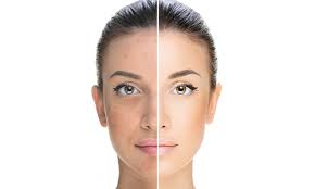 Split image of a face, one side with blemishes, the other clear