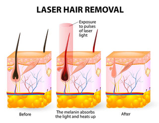 Laser hair removal infographic