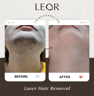 laser hair removal