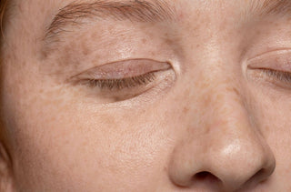 Ageing Skin Spots