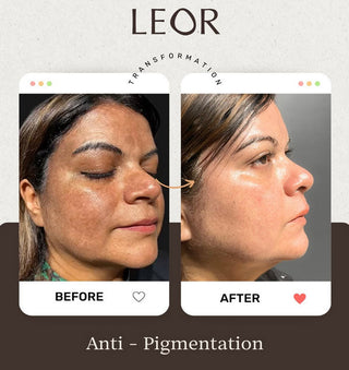 hyperpigmentation