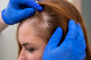 Patchy Hair Loss
