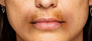 pigmentation around mouth