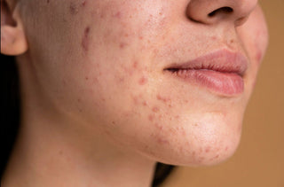 Pimples on Face