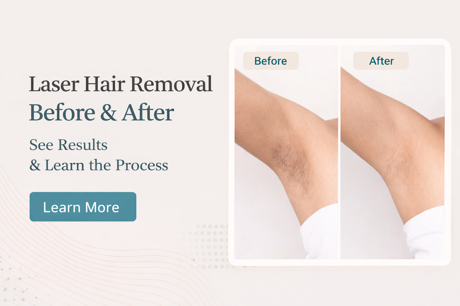 Laser Hair Removal Before & After: Smooth, Hair-Free Skin