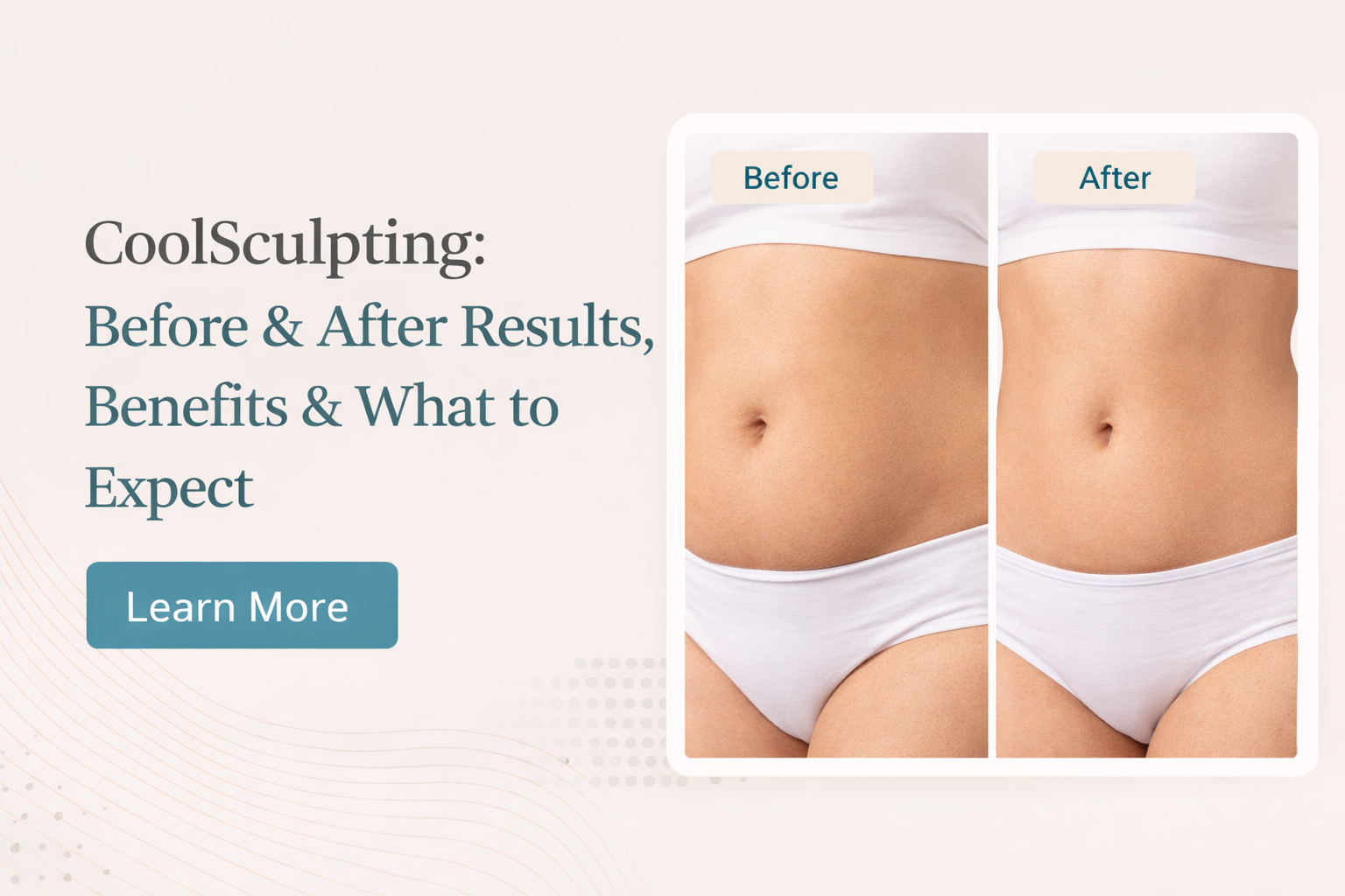 CoolSculpting Before & After: Real Results