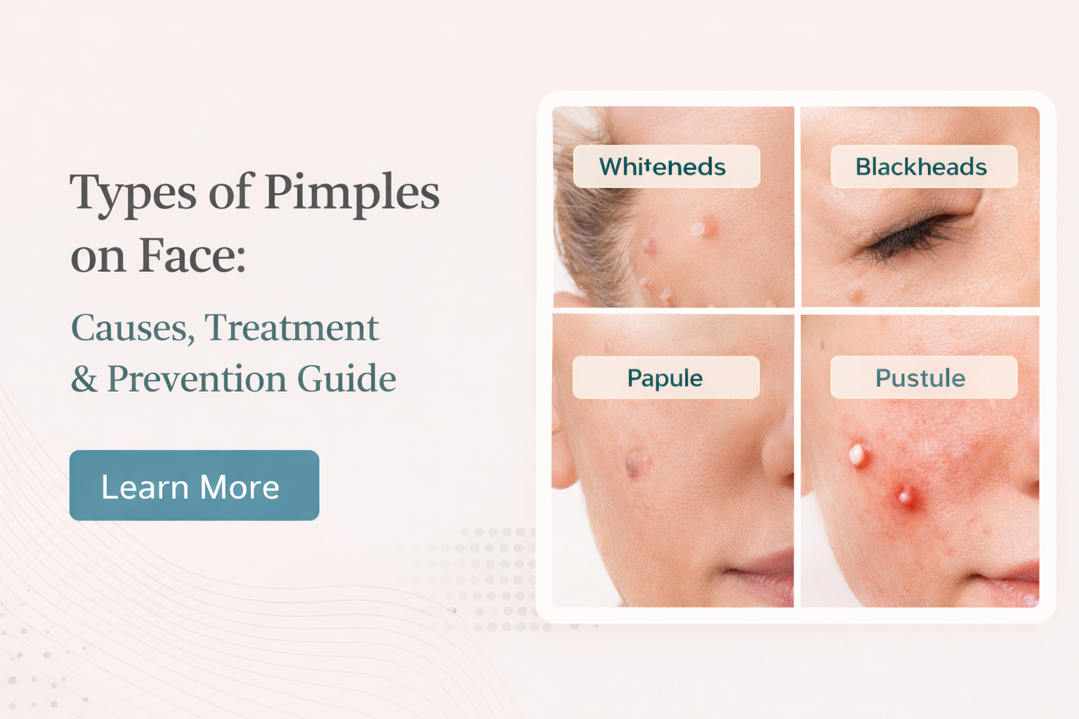 Types of Pimples on Face: A Visual Guide