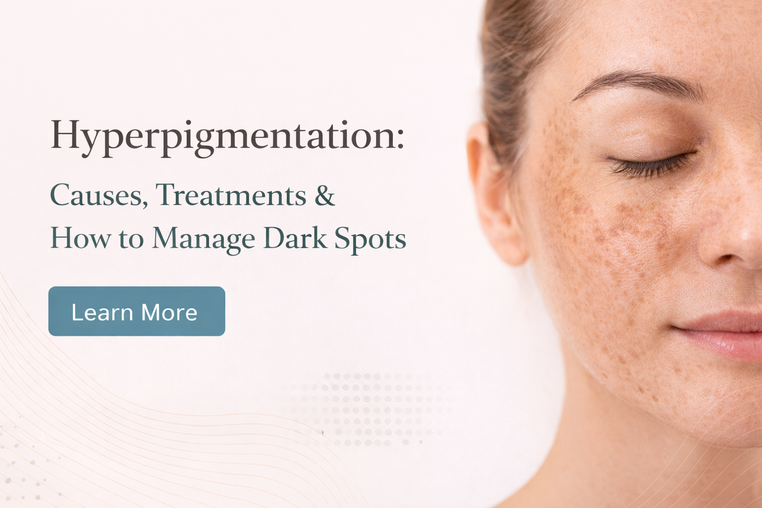 Hyperpigmentation: Comprehensive View